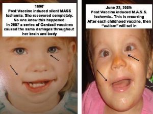 vaccine damage ischemia